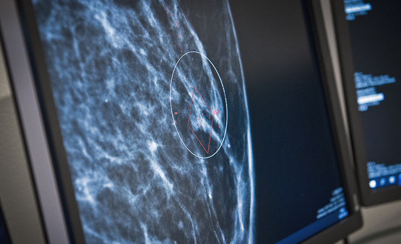 Först med AI i mammografi